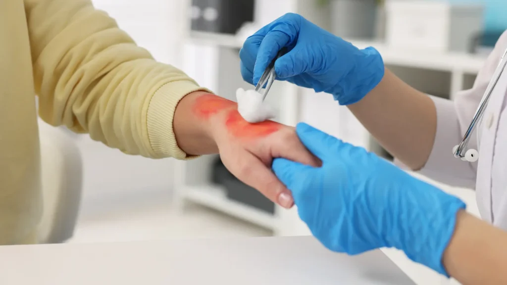 Healthcare worker treating a burn wound on a person's hand with gauze.