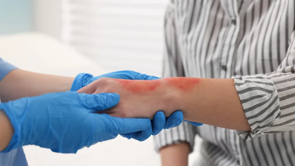 Healthcare professional treating a burn injury on a patient’s arm