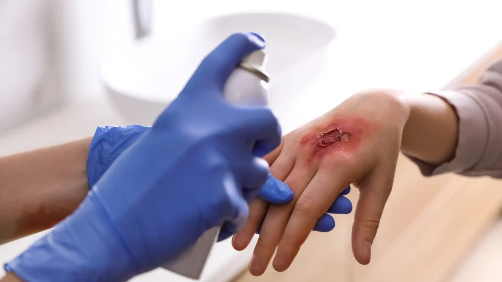 Healthcare professional applying antiseptic spray to a hand wound.