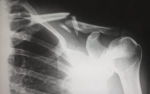 Bone Fractures from a Motorcycle Accident in New Jersey